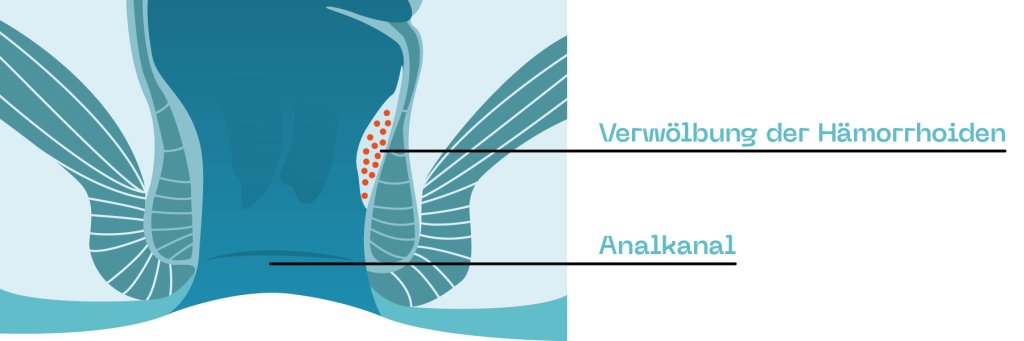 Hämorrhoiden_ProctyClean_Grad1.