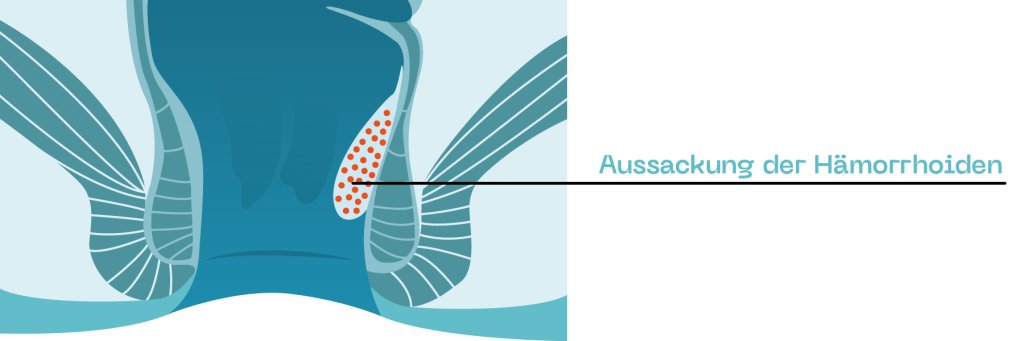 Hämorrhoiden_ProctyClean_Grad2.