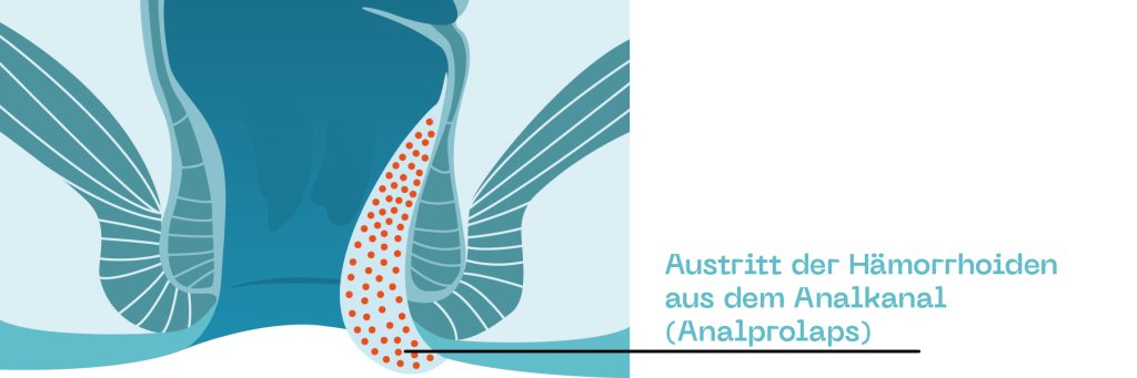 Hämorrhoiden_ProctyClean_Grad4.